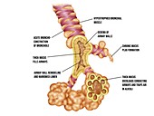 Lung bronchioles and alveoli in bronchiolitis, illustration