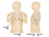 Placement of ECG electrodes, illustration