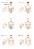 Immune system effects of baby milk, illustration