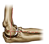 Elbow joint alignment, illustration