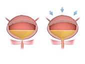 Stress incontinence, illustration