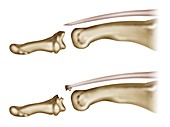 Fingertip tendon injury, illustration