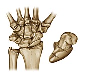 Scaphoid fracture of the wrist, illustration