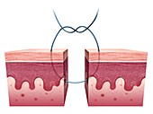 Surgical suturing of skin, illustration