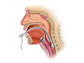 Orotracheal intubation, illustration