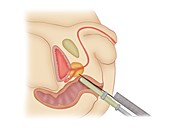 Prostate disorder treatment, illustration