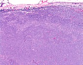 Diffuse large B-cell lymphoma, light micrograph