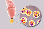 Gonorrhoea infection in male, illustration