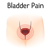 Bladder pain, illustration