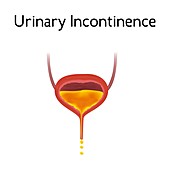 Urinary incontinence, illustration