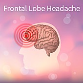 Frontal lobe headache, illustration