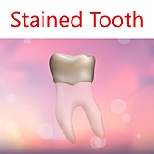 Stained tooth, illustration