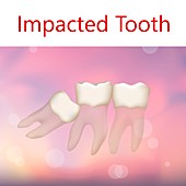 Impacted tooth, illustration