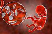 Transplacental transmission of Toxoplasmosis, illustration