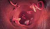 Tapeworm infestation in human intestine, illustration