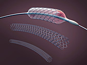 Stents and balloon catheters, illustration