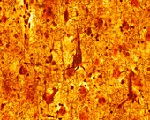 Neurofibrillary tangles, light micrograph