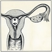 Intrauterine device, illustration