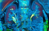 Kidneys and duplicated ureter, CT scan