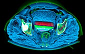 Urinary excretion to bladder, CT scan