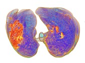 Lungs affected by Covid-19 atypical pneumonia, 3d CT scan