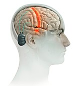 Electrodes implanted in brain, illustration