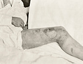 Mustard gas burns, First World War