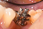 Molar with posts for dental crown
