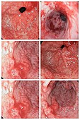 Gastric antral vascular ectasia, endoscopy images