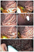 Gastric polyps and endoscopy camera capsule, endoscopy image