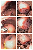 Ulcerated gastrointestinal stromal tumours, endoscopy images