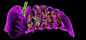 Lungs affected by Covid-19 atypical pneumonia, 3D CT scan