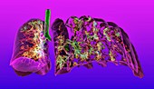 Lungs affected by Covid-19 atypical pneumonia, 3D CT scan