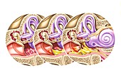Otitis media ear infection, illustration