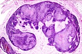 Chronic Hodgkin's lymphoma, light micrograph