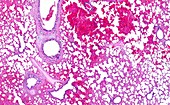 Lobar pneumonia haemorrhagic edema period, light micrograph