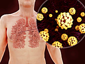 Coronavirus lung infection, illustration