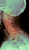 Osteoarthritis of the cervical spine, X-ray