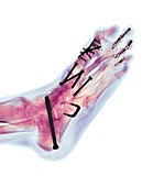 Surgical fixation for rheumatoid arthritis of feet, X-ray