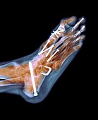 Surgical fixation for rheumatoid arthritis of feet, X-ray