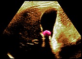 Gallstone, ultrasound scan