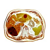 Liver cancer, CT scan