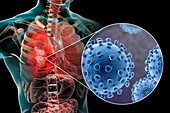 Coronaviruses causing pneumonia, illustration