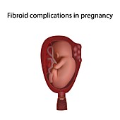 Fibroid complications in pregnancy, illustration