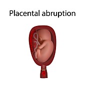 Placental abruption, illustration
