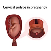 Cervical polyps in pregnancy, illustration