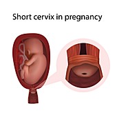 Short cervix in pregnancy, illustration