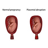 Placental abruption and healthy pregnancy, illustration