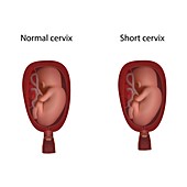 Short cervix and normal cervix in pregnancy, illustration