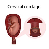 Cervical cerclage, illustration